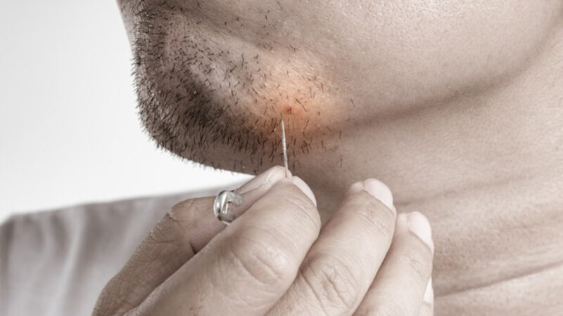 Comment faire mûrir un bouton mal placé ?